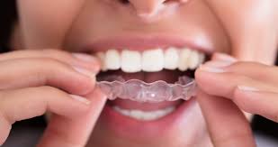 It is strong, but it takes up to 48 hours to set completely. Will I Need To Wear A Retainer After Braces Guide To Permanent Retainers