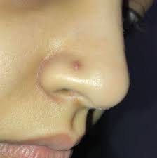 Red Squishy Texture Bump On My Piercing Nose Please Help Story In The Comments Piercing