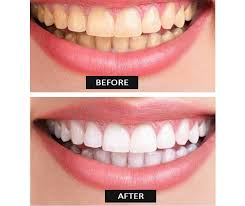 Pin On Teeth