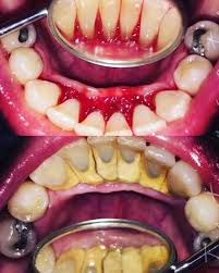 Within a few months, you will have aligned teeth and a beautiful smile. Pin By Lucie Rybarova On Zuby Brushing Teeth Sonic Toothbrush Braces Toothbrush