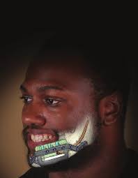 Tumor Removal with Immediate Reconstruction and Dental Rehabilitation in  One Stage