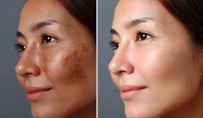 CO2 Laser Resurfacing for Austin , TX