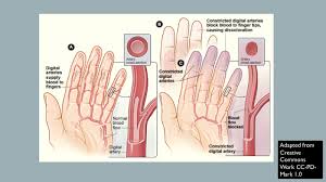 Communities>neurology> can renauds syndrom occur in the feet. Figure Raynaud S Phenomena Contributed By Creative Commons Cc Pd Mark 1 0 Statpearls Ncbi Bookshelf