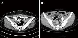 Ob/gyns located in westport, ct & fairfield, ct endometriosis is one of the most common lower abdomen conditions women have, and it's responsible for heavy, painful periods and some cases of infertility. Intestinal Endometriosis Diagnostic Ambiguities And Surgical Outcomes