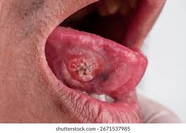 Image result for Puchýře na jazyku