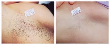 Laser hair removal over time will reduce hair growth. Best Laser Hair Removal In Melbourne Dermacare Dermacare Cosmetic Laser And Skin Clinic Melbourne