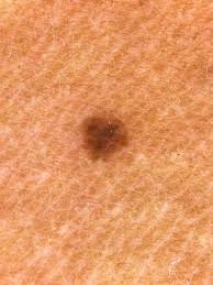 Image result for Macule