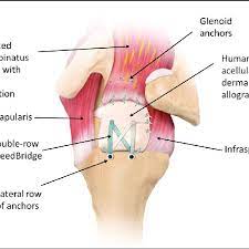 Smartdraw includes 1000s of professional healthcare and anatomy chart templates that you can modify and make your own. Diagram From Superolateral View Of A Left Shoulder Illustrating The Fi Download Scientific Diagram
