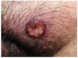 Image result for syphilis ulcer