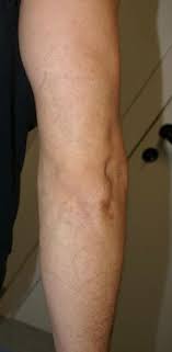 Before and after laser tattoo removal consultation. Laser Tattoo Removal Seattle Seattle S Premier Tattoo Removal