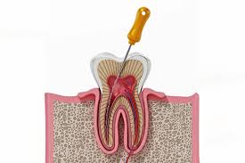 How Long Does Root Canal Last? Expert Insights