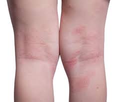 Pana si muscaturile de tantar imi trec greu si ramane urma. Porumbel Cerc De Rulment RÄmÄÈiÈe Pete Rosii Pe Picioare Si Mancarimi Apitotal Ro