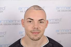 Serkan aygin clinic ist eine haartransplantation türkei empfehlung. Erfahrungsbericht Haartransplantation In Der Turkei Mit Health Travels Bunte De