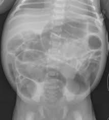 Image result for Adynamic Ileus