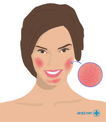 Rosacea Behandlung Ursachen Und Die Richtige Therapie Fur Dich Dr Seb
