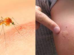 Most people experience some kind of skin reaction after being bitten by a mosquito. Why Do Mosquito Bites Itch Mosquito Saliva Is The Culprit