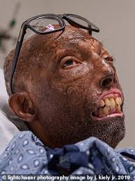 The song was also released as the second music video from the album on 19 january 2009. Face Transplant Recipient Adjusting To New Facial Features Daily Mail Online