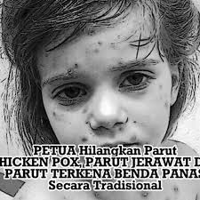 Aduhai, jerawat dah lama tak tumbuh. Petua Hilangkan Parut Chicken Pox Parut Jerawat Dan Parut Terkena Benda Panas Secara Tradisional Bubblynotes Malaysia Parenting Lifestyle Blog