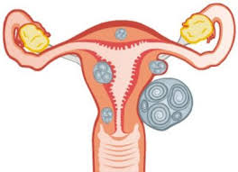 Myome oder gebärmutterwucherungen sind langsam wachsende, gutartige tumoren der gebärmutter und zählen zu den häufigsten tumoren bei frauen im gebärfähigen alter. Myome