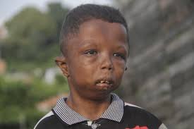 ¡Extraordinario! El niño con Síndrome de Rubinstein-Taybi