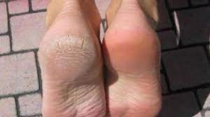 Le remède miracle pour lutter contre les pieds secs. Le Remede De Grand Mere Teste Et Approuve Contre La Corne Aux Pieds