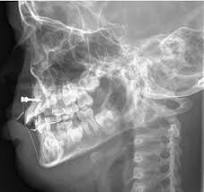 Mandible immobilization with a screw-and-stitch technique ...