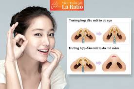 Thu gọn cánh mũi duy trì hiệu quả vĩnh viễn không?