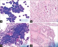 Moreover, bethesda classification score 3 exhibited the highest diagnostic value for thyroid cancer; Risk Of Malignancy In Thyroid Atypia Of Undetermined Significance Follicular Lesion Of Undetermined Significance And Its Subcategories A 5 Year Experience Thakur A Sarin H Kaur D Sarin D Indian J Pathol