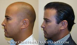 Hair Transplant Surgery For Men And Women in Georgia Madison James Spring