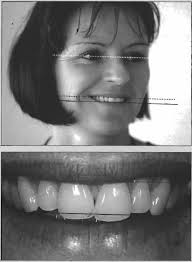 Quiz: Rehabilitación estetica ordinario (dental)