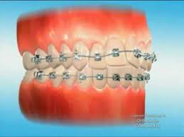 How to get your molars to stop hurting? Orthosmile First Days In Braces Youtube