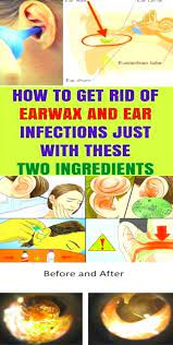 These Two Ingredients Can Eliminate Earwax And Ear Infections Home Health Care Ear Wax Ear Infection Ear Infection Remedy