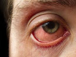 In Some Cases Pink Eye Might Be An Early Symptom Of Covid 19
