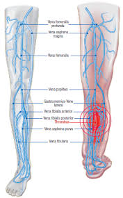 Tiefe Beinvenenthrombose