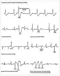 Ekg Interpretation
