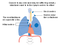 According to the american cancer society, lung cancer is the second most common form of cancer in both men and women. Lung Cancer Wikipedia