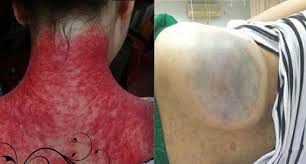 He painless bruise marks on a child from the traditional chinese guasha/scraping treatment was mistaken by child protection services as evidence of abuse and neglect. å°å¿ƒ ä¸­æš' åˆ¥äº‚åˆ®ç—§ å°'å¥³èº«ä¸Šç«Ÿåˆ®å‡º å¯æ€•çš„è¶³çƒ åŽŸå› åš‡æ­»äººäº† Loveåˆ†äº«