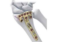 2.4mm Variable Angle Distal Radius Volar Plate | J&J Medical ...