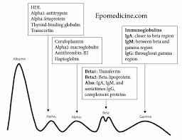 May demonstrate a paraprotein band. M Spike Epomedicine