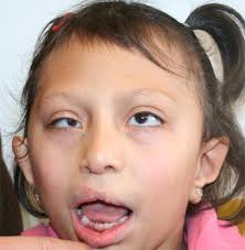 Genetics of anophthalmia and microphthalmia. Part 2: Syndromes associated  with anophthalmia–microphthalmia