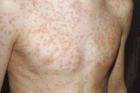 Image result for Rubella