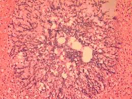 • other than hp bacterial infections: A Rare Presentation Of Zygomycosis Mucormycosis And Review Of The Literature Journal Of Clinical Pathology