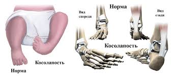 It's not painful for babies, but it can become painful and make it club foot is usually diagnosed after a baby is born, although it may be spotted during the routine. Is It Possible To Cure Clubfoot Surgical Treatment Of Clubfoot Treatment Of Various Forms Of Clubfoot In Children