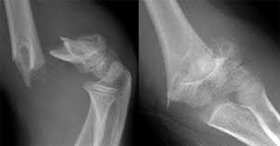 Supracondylar fractures of the humerus in children. Pediatric Humeral Fracture Physiopedia