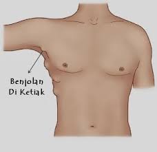Sedang mencari solusi cara menghilangkan benjolan di ketiak secara alami ??? Cara Menghilangkan Benjolan Di Ketiak Cara Menghilangkan Benjolan Di Ketiak