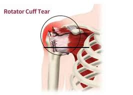 Image result for Rotator Cuff Rupture