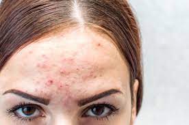 Inflammatory acne tends to affect the face and is usually either due to increased oil production, follicular plugging, excess bacterial growth of propionibacterium acnes, or. Folliculitis What Is It How Is It Treated U S Dermatology Partners Blog