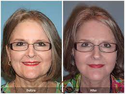 The right spine surgeon will let you know if surgery is appropriate for your situation. Best Facelift Surgeon Near Me In Costa Mesa Ca Facial Enhancement California