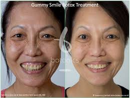 Causes and treatments while your gums are a crucial your mouth, you probably don't want to show them off every although it's generally not an urgent issue, individuals with a gummy smile often feel less confident about their smile. How To Treat Gummy Smile With Botox