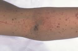 Bruise on knee, breast, foot & hip. Immune Thrombocytopenia And Purpura